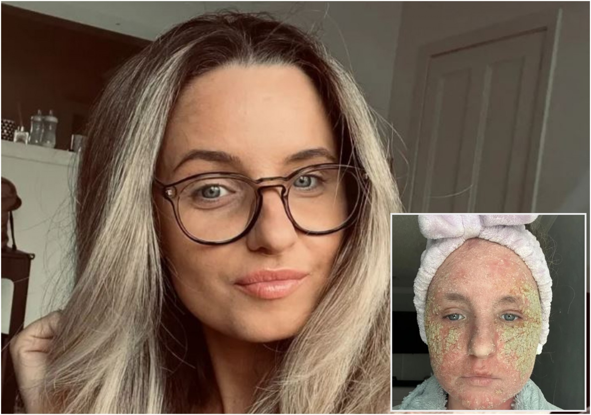 „Кожата ми позелене, имам живи рани, а сето тоа поради оваа крема“: Порано беше убавица, сега цела кожа ѝ се лупи и косата ѝ паѓа