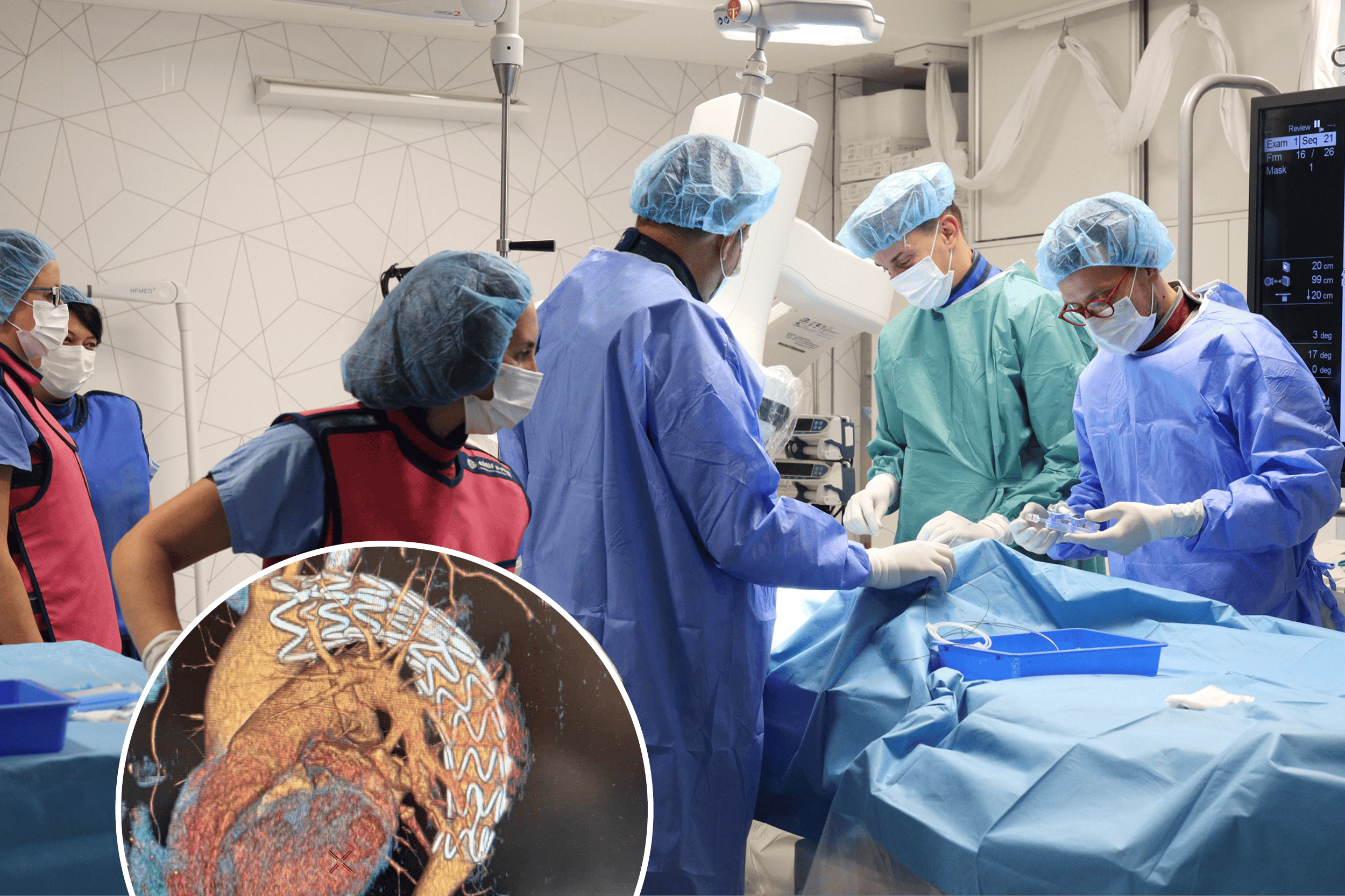 ПРВПАТ ВО МАКЕДОНИЈА ВО „АЏИБАДЕМ СИСТИНА“ ИЗВЕДЕНА КОМПЛЕКСНА ЕНДОВАСКУЛАРНА ПРОЦЕДУРА НА ТОРАКАЛНАТА АОРТА – ТЕВАР СО Т.Н. IN SITU ФЕНЕСТРАЦИЈА