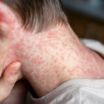 Над 150 невакцинирани деца ќе бидат во изолација 21 ден поради епидемија на морбили во Америка