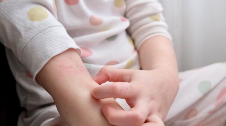 Стресот од детството го зголемува ризикот од појава на псоријаза