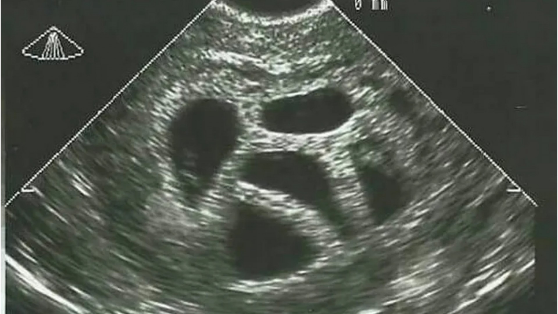 Доктор видел петорка на ултразвук, па ја советувал идната мајка да абортира: 20 години подоцна ја објави таа фотографија