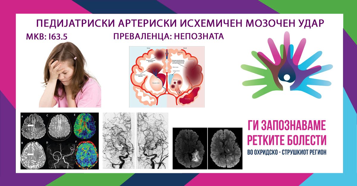 Денес го одбележуваме Светскиот ден на мозочен удар