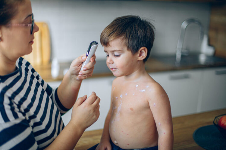 ПЕДИЈАТРИТЕ УКАЖУВААТ: Првите симптоми на овчи сипаници често поминуваат незабележани