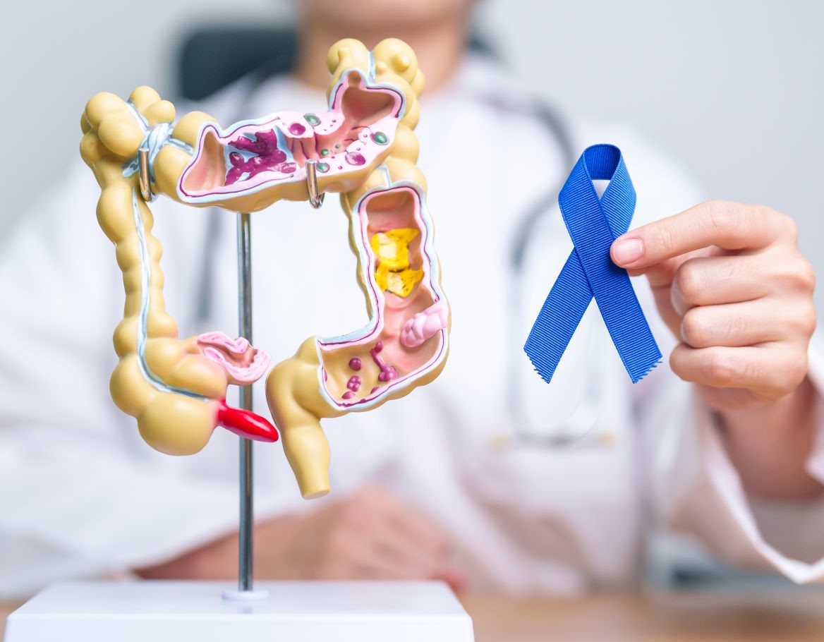 ПЕТ ВИДОВИ ХРАНА КОИ ДОКТОРИТЕ НИКОГАШ НЕ ГИ ЈАДАТ ПОРАДИ РИЗИК ОД РАК НА ДЕБЕЛОТО ЦРЕВО