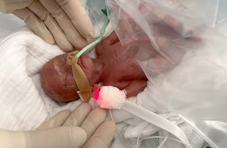 МАЛО ЧУДО СО ГОЛЕМА ВОЛЈА ЗА ЖИВОТ: Родено 16 недели порано, тешко само 300 грама – денес здраво и насмеано бебе