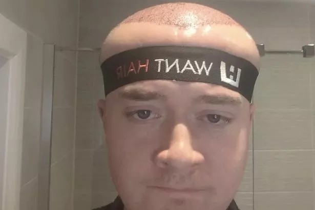 По трансплантација на коса, маж со огромно чело: „Изгледам како да можам да ја видам иднината“