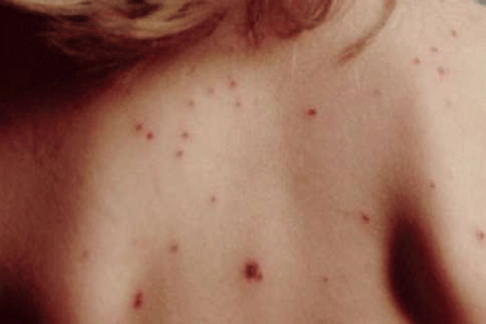 Научници се сомневаат на можна врска меѓу тетоважите и ракот на кожата