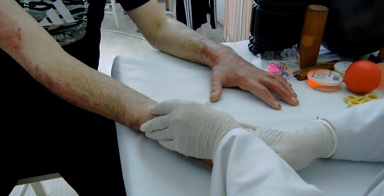 Повредени од трагедијата во Пулс и по девет месеци се уште одат на физикална терапија