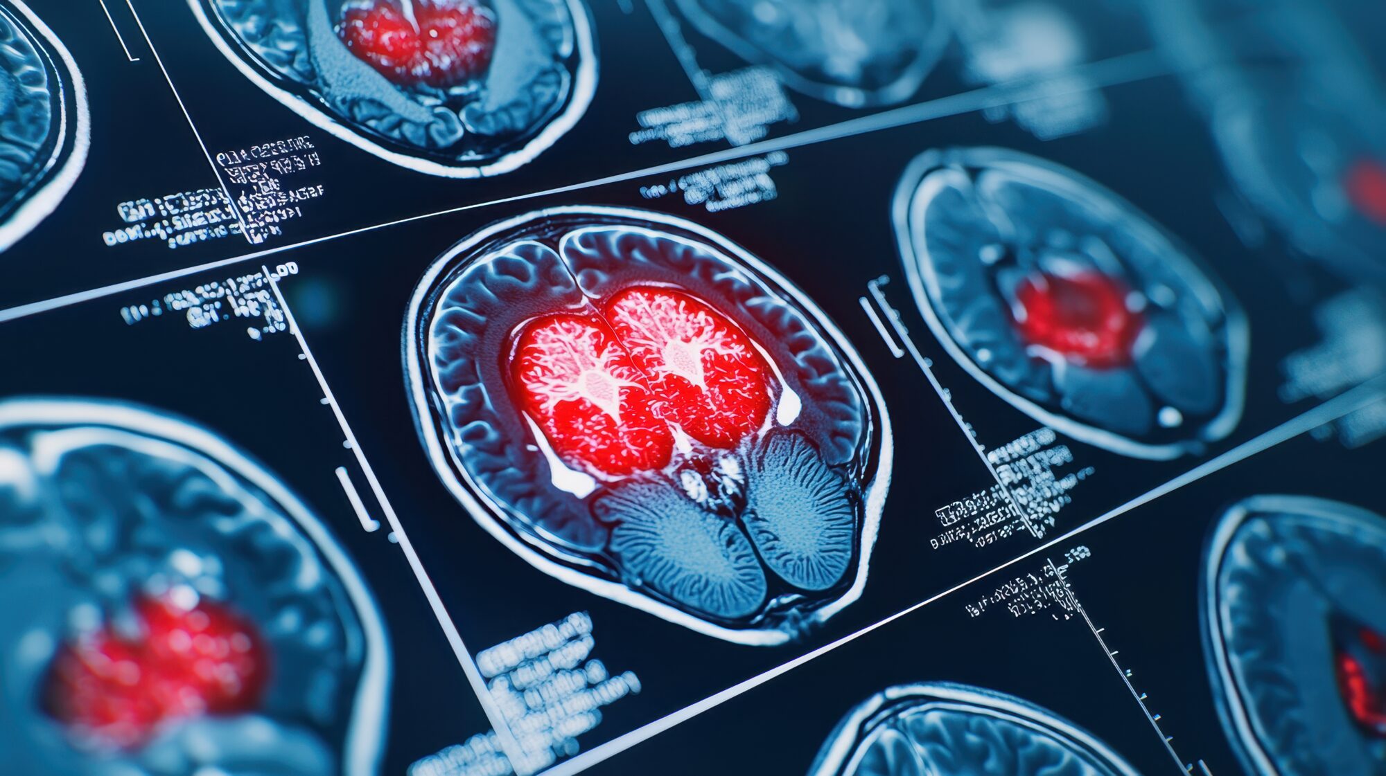 РАК НА МОЗОК ВО СТАДИУМ 4 КОЈ МОЖЕ ДА БИДЕ ФАТАЛЕН ЗА 6 МЕСЕЦИ: ГЛИОБЛАСТОМОТ РАСТЕ МНОГУ БРЗО И СЕ ШИРИ НА ОКОЛНИТЕ ТКИВА