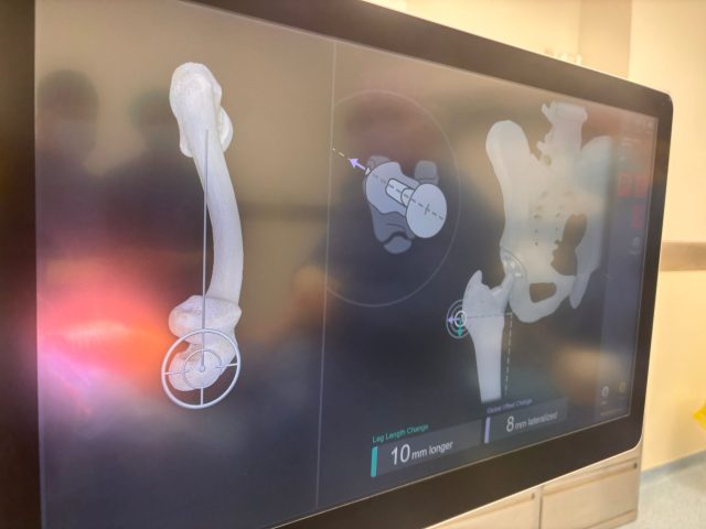 Извршена првата операција на колк со помош на навигациски систем