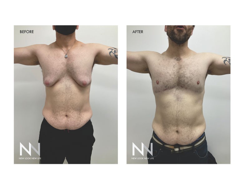 Сè повеќе мажи во Америка го прават најпопуларниот естетски зафат – операција за намалување на гради и велат: Ми го врати животот!