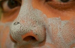 Имала црни митисери на носот – Еве како ги отстранила за две минути (рецепт)