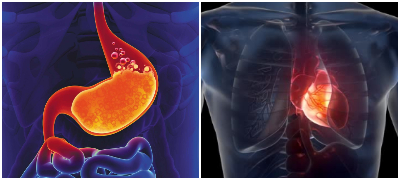 Обилен оброк, инфаркт или чир на желудник: Можни причини зошто имате киселини