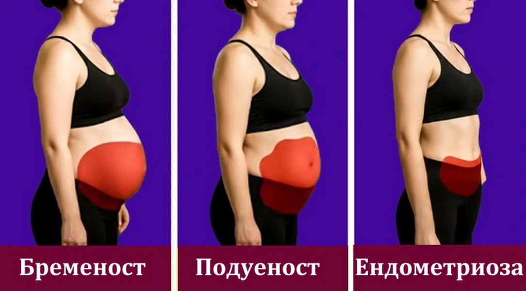 Помалку познати симптоми на ендометриозата што не смеат да се игнорираат