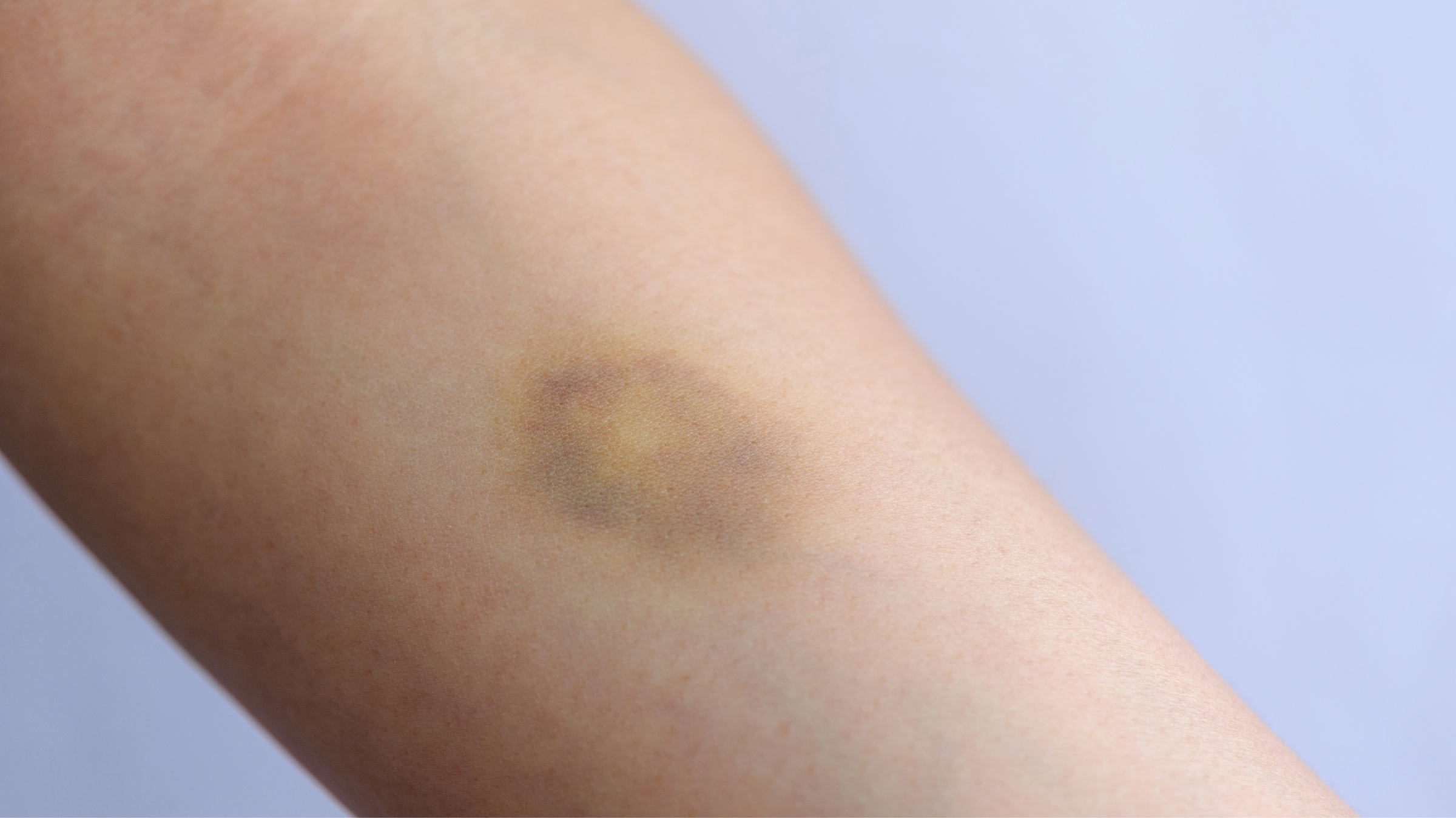 МОДРИНКИТЕ се појавуваат „без причина“ – Што се обидува да Ви каже телото?