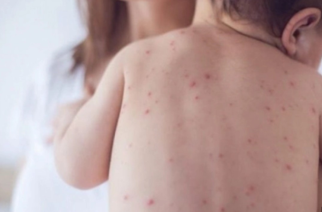 Шест европски земји го загубија статусот на земји без мали сипаници додека случаите нагло растат низ целиот континент