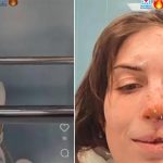 Елеонора го преживеа ужасот во барот во Кран Монтана- ги покажа раните и раскажа како преживеала