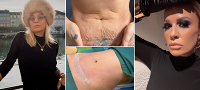 Миа Костова направи липосукција на стомакот: „Бев будна во текот на операцијата, ме чинеше околу 1500€“