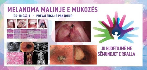 ГИ ЗАПОЗНАВАМЕ РЕТКИТЕ БОЛЕСТИ: МАЛИГЕН МЕЛАНОМ НА СЛУЗНИЦАТА