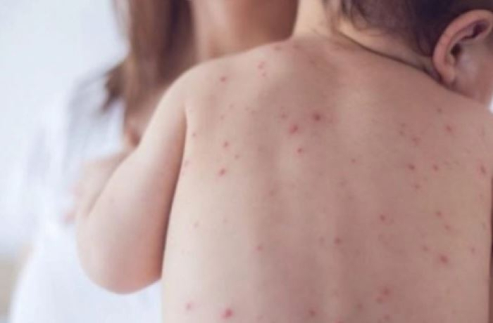 Епидемија на мали сипаници во северен Лондон