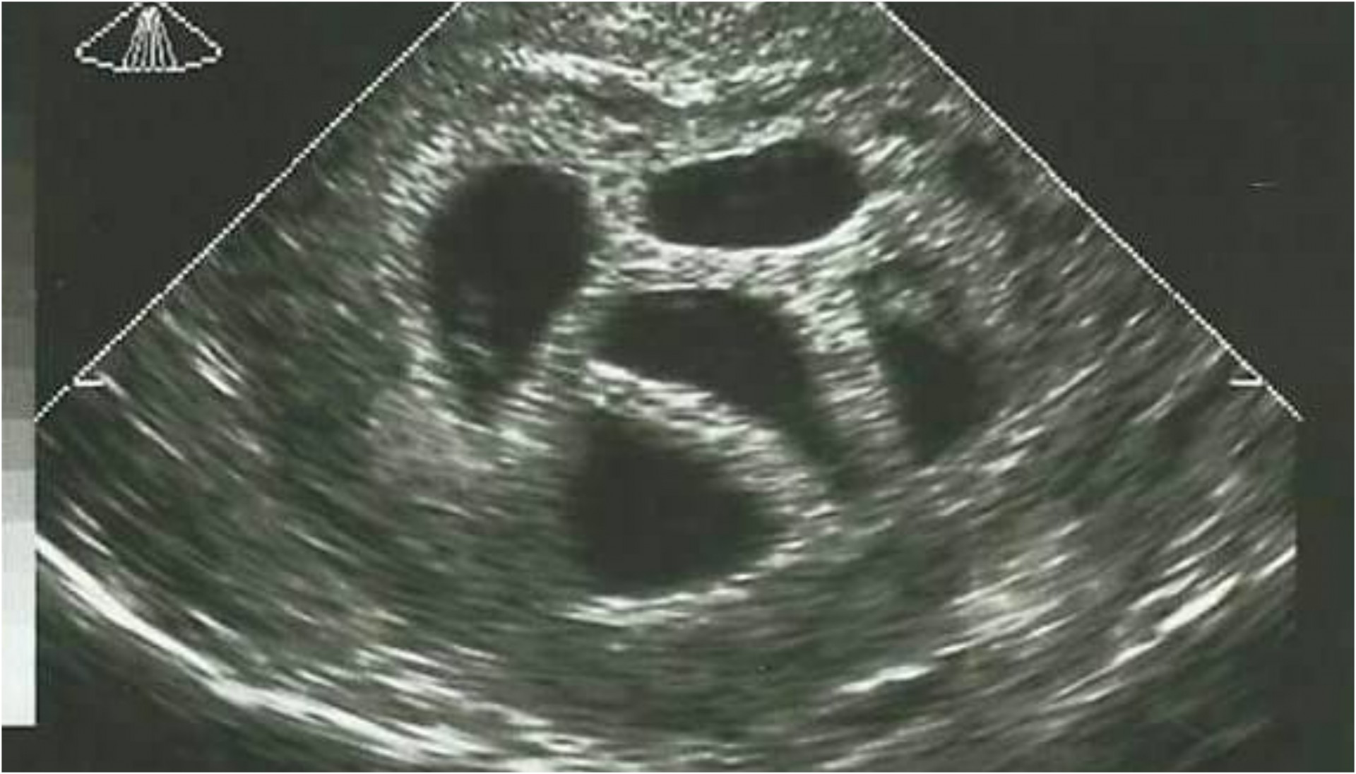 Ја советувал мајката да абортира, откако ја видел петорката на ултразвук: Видете го ова после 20 години