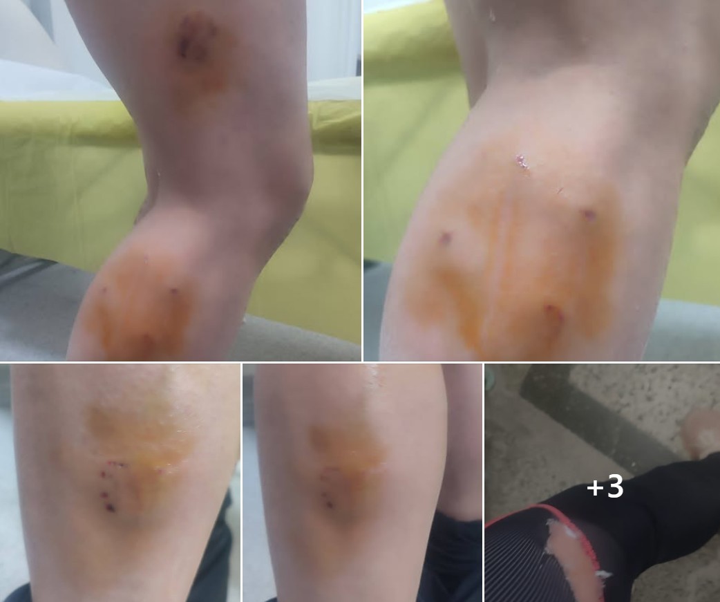 „Побрзо во животот немам трчано, трчав и викав по нив да престанат да ме касаат“: потресно сведоштво од скопјанка нападната од глутница кучиња