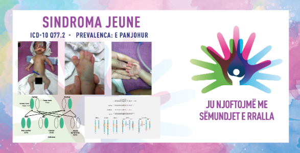 ГИ ЗАПОЗНАВАМЕ РЕТКИТЕ БОЛЕСТИ: СИНДРОМ НА ЖЕНУ/ЖЕНУ-АСФИКСИЈАЛНА ТОРАКАЛНА ДИСТРОФИЈА