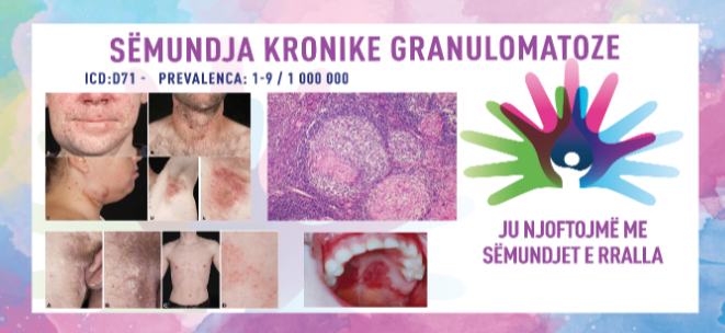 ГИ ЗАПОЗНАВАМЕ РЕТКИТЕ БОЛЕСТИ: ХРОНИЧНА ГРАНУЛОМАТОЗНА БОЛЕСТ (ХГБ)