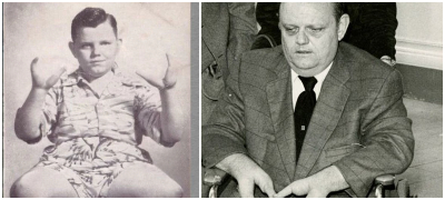 Поради деформитет имал само 2 прста на дланките, го убил свршеникот на ќерка му: Мрачната приказна за „момчето јастог“