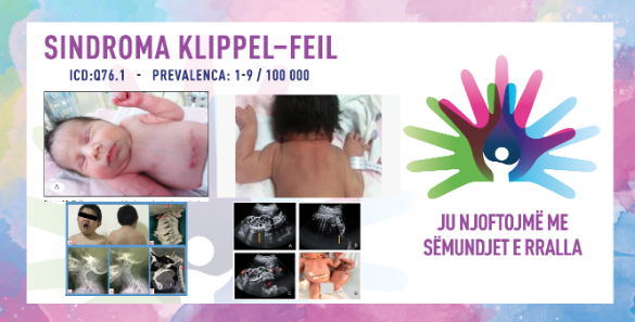 ГИ ЗАПОЗНАВАМЕ РЕТКИТЕ БОЛЕСТИ: КЛИПЕЛ–ФЛЕИЛОВ СИНДРОМ