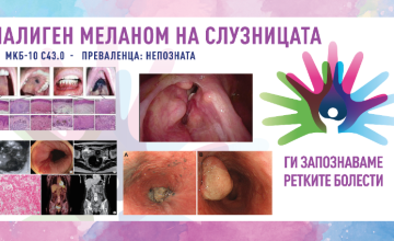 Ги запознаваме ретките болести 2026: МАЛИГЕН МЕЛАНОМ НА СЛУЗНИЦАТА