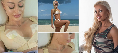 Србинка со искрени фотки од болница по ставањето силикони: „Ги правев градите, но кога не треба да се оперирате?“