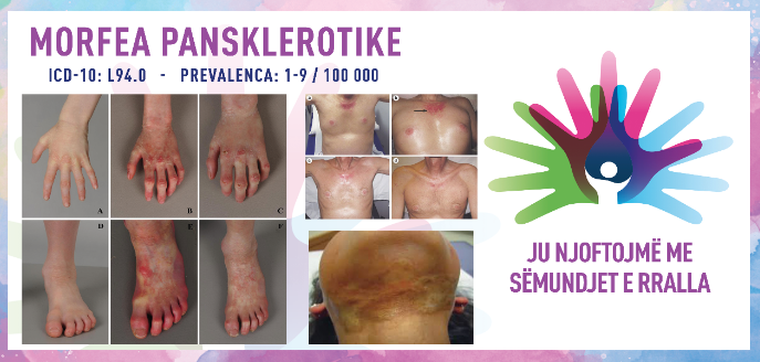 ГИ ЗАПОЗНАВАМЕ РЕТКИТЕ БОЛЕСТИ: ПАНСКЛЕРОТИЧНА МОРФЕА