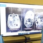 Во Клиника Жан Митрев успешно оперирана 60-годишна пациентка со комплексен тумор на базата на черепот