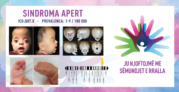 ГИ ЗАПОЗНАВАМЕ РЕТКИТЕ БОЛЕСТИ: АПЕРТОВ СИНДРОМ