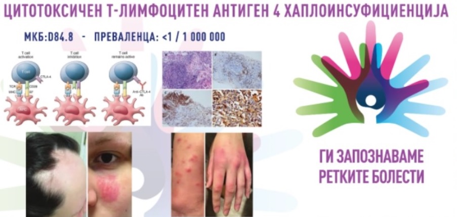 Живот со CTLA-4: ретка генетска состојба што го нарушува имунитетот