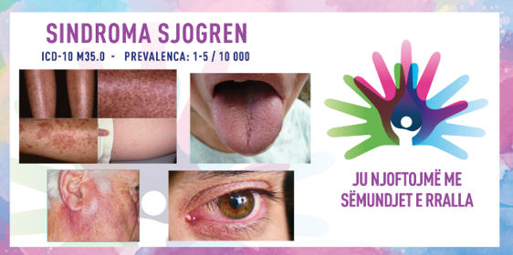 ГИ ЗАПОЗНАВАМЕ РЕТКИТЕ БОЛЕСТИ: СЈОГРЕНОВ СИНДРОМ
