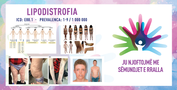 ГИ ЗАПОЗНАВАМЕ РЕТКИТЕ БОЛЕСТИ: ЛИПОДИСТРОФИЈА