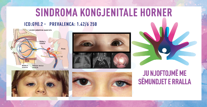 ГИ ЗАПОЗНАВАМЕ РЕТКИТЕ БОЛЕСТИ: КОНГЕНИТАЛЕН СИНДРОМ НА ХОРНЕР