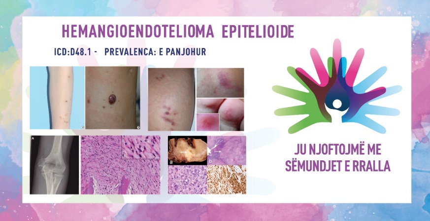 ГИ ЗАПОЗНАВАМЕ РЕТКИТЕ БОЛЕСТИ: ЕПИТЕЛОИДЕН ХЕМАНГИОЕНДОТЕЛИОM (ЕХЕ)