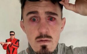 Том Аспинал ги покажа очите еден ден по операцијата