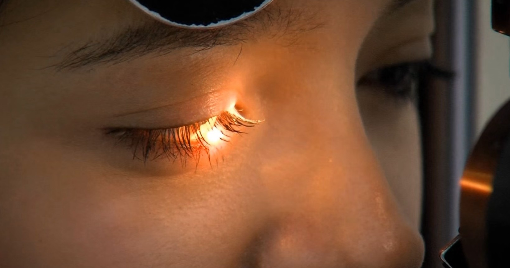 Спасен видот кај 16 пациенти со трнасплантација на рожница