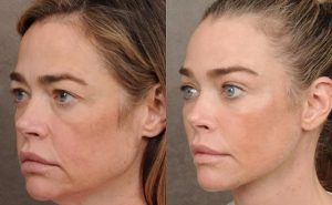 (ФОТО) Го споделила своето искуство – Дениз Ричардс отворено зборувала за лифтингот на лице и ги покажа ефектите: „Не е сè во серуми и вежбање“