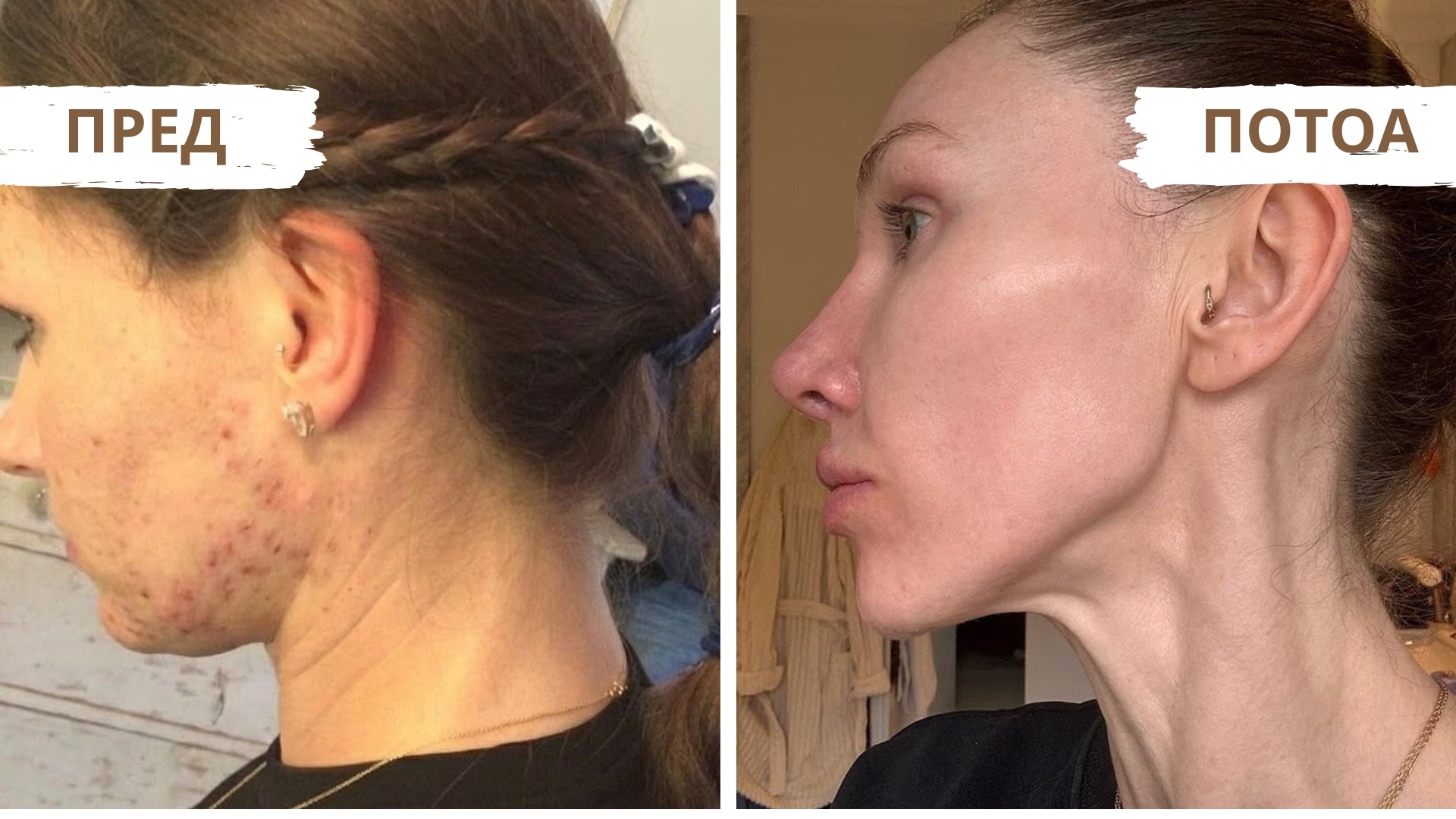 „Со години се срамев од цистичните акни на лицето – Како тоа ми помогна да креирам бизнис со кој им помагам на илјадници жени?“