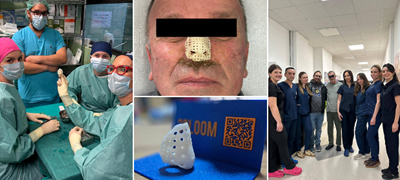 Првпат во Македонија испечатен 3Д имплант за нос – пациентот го загубил носот од малигна болест