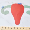 Како да забремените со ендометриоза?