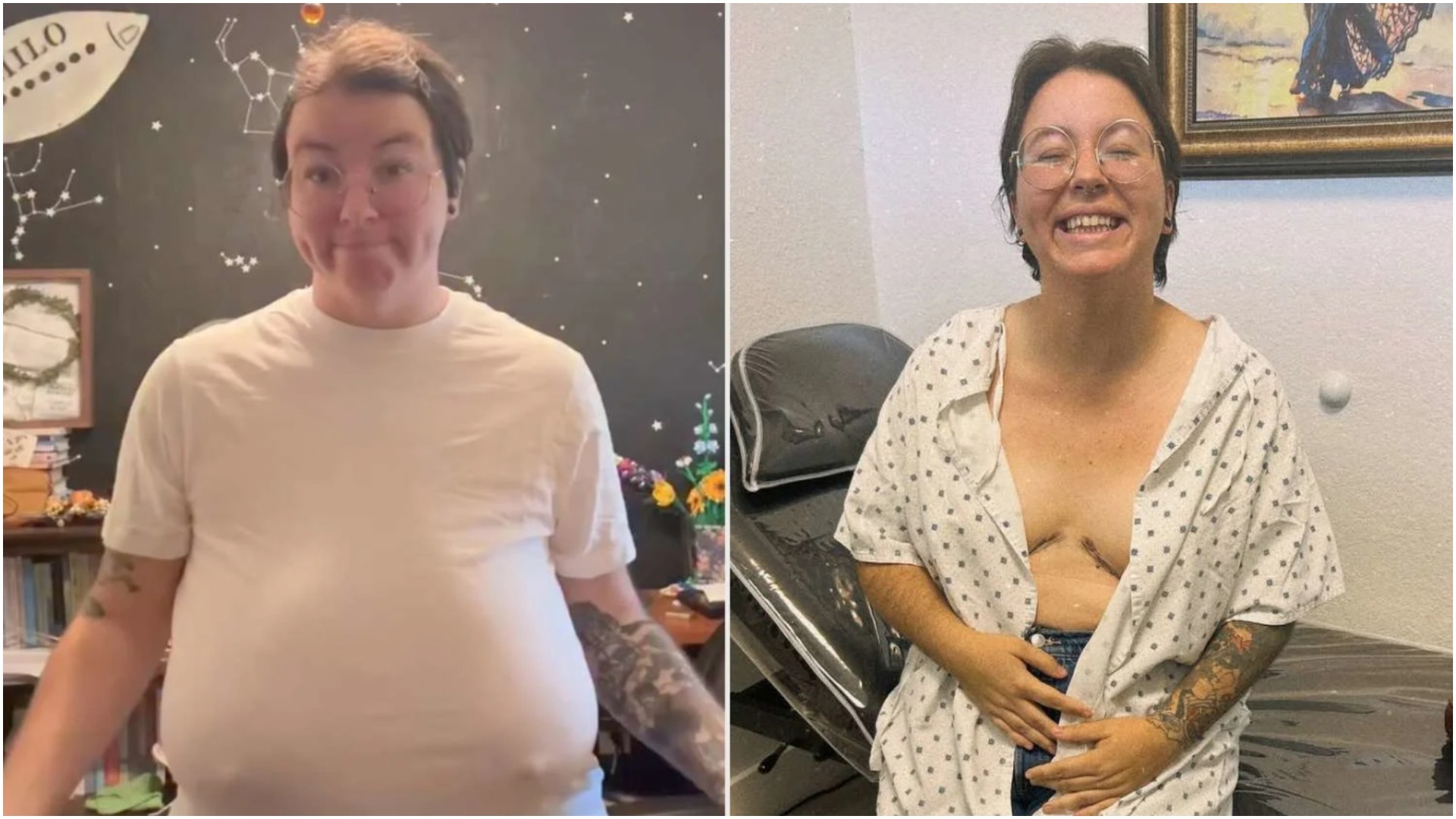 Градите со тежина од 5 килограми ѝ го отежнувале животот: Решение нашла со операција од 11.000 евра