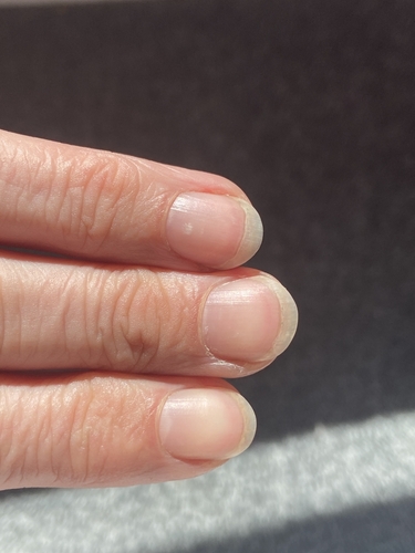 Добро погледнете ги вашите нокти: Тие покажуваат дали имате сериозна болест