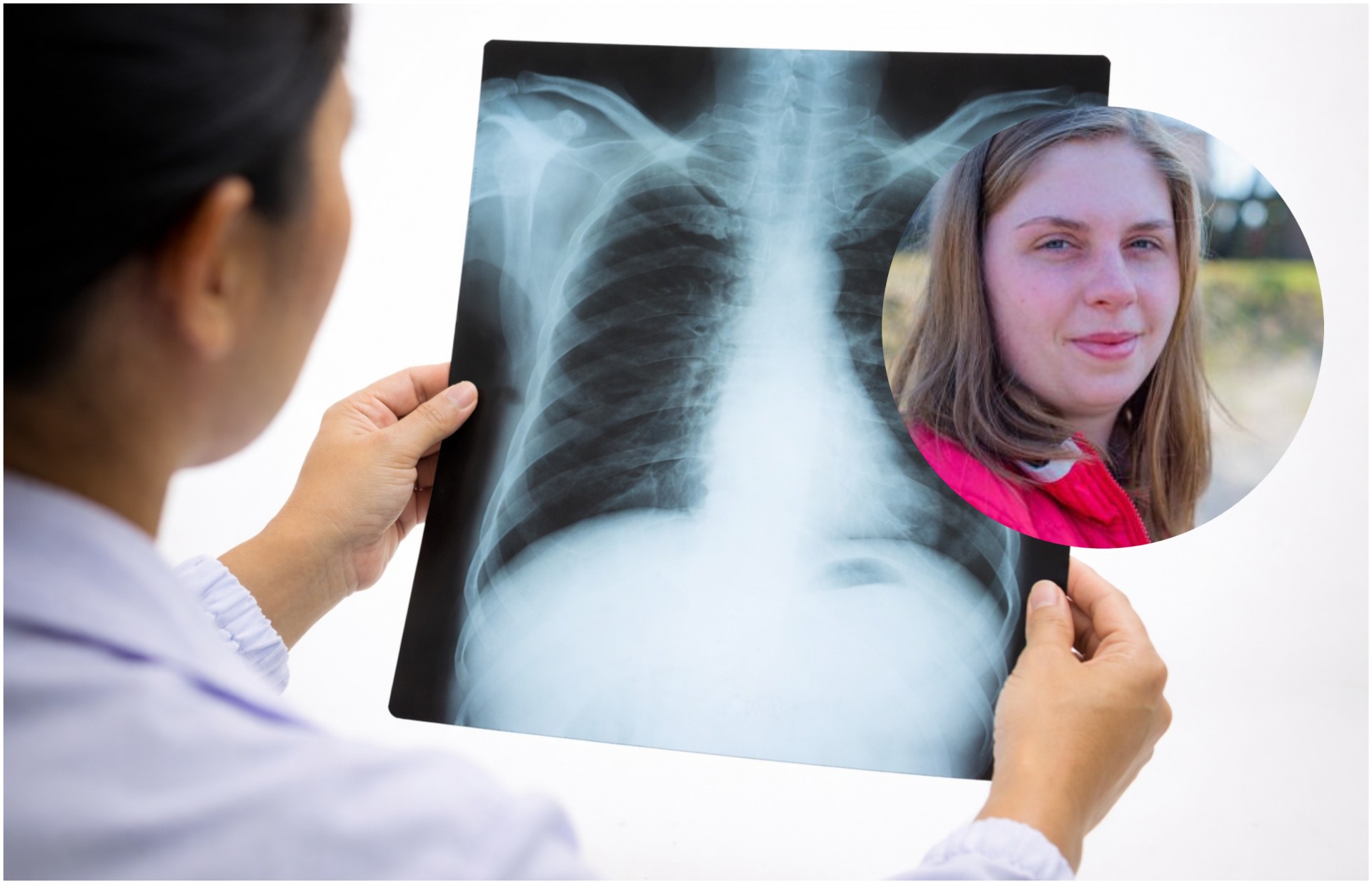 Девојка од 22 години добила рак на бели дробови буквално „преку ноќ“: Дали оваа навика е виновна за нејзината тешка состојба?