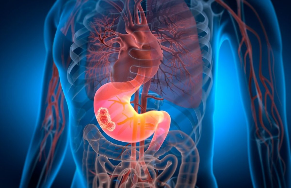 Невидливи знаци на рак на панкреас: Ве уништува одвнатре пред да сфатите дека сте болни